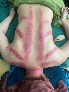 cạo gió giác hơi đà nẵng