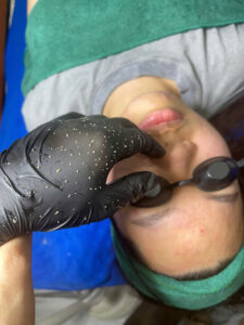 trị mụn hoà khánh đà nẵng